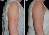 Fraxel laser resurfacing