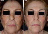 Fraxel Laser Resurfacing with Obagi NuDerm