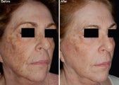 Fraxel Laser Resurfacing