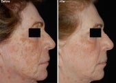 Fraxel Laser Resurfacing