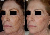 Fraxel Laser Resurfacing