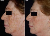 Fraxel Laser Resurfacing