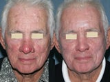Fraxel repair in conjunction with multiple lasers