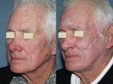 Fraxel repair in conjunction with multiple lasers
