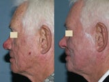 Fraxel repair in conjunction with multiple lasers
