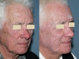 Fraxel repair in conjunction with multiple lasers