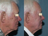 Fraxel repair in conjunction with multiple lasers