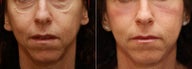 Fraxel Repair for under eye bags