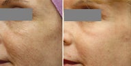 Fraxel Repair Resurfacing for sun damage and wrinkling