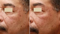 Fraxel Repair 2mm Spot
