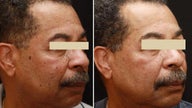Fraxel Repair 2mm Spot