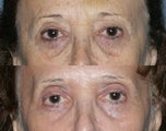 Fraxel Repair in Combination with other lasers yields best results