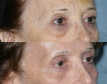 Fraxel Repair in Combination with other lasers yields best results