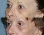 Fraxel Repair in Combination with other lasers yields best results