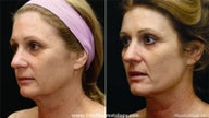 Fraxel CO2 Repair for skin tightening and sun damage
