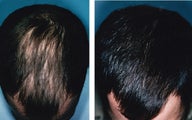 Medical treatment for hair loss (no surgery)