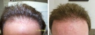 Medical treatment for hair loss (no surgery)