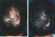 Medical treatment for hair loss (no surgery)