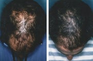 Medical treatment for hair loss (no surgery)