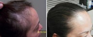 Female medical treatment for hair loss (no surgery)