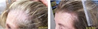 Female medical treatment for hair loss (no surgery)