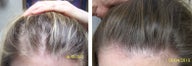 Female medical treatment for hair loss (no surgery)