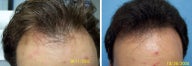 Medical treatment for hair loss (no surgery)
