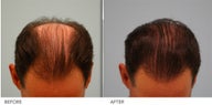 Hair Restoration