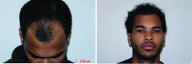 DIFF ANGLES - Hair Transplant