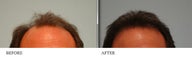 Hair Transplant