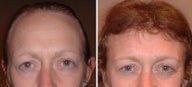 Hairline lowering