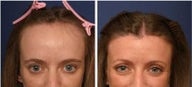 Hairline lowering