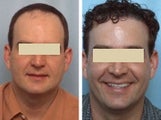 Fleming/Mayer flap