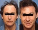 Hair replacement