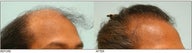 Hair Transplant