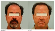 Hair Transplant
