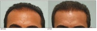 Hair Transplant