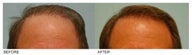 Hair Transplant