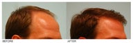 Hair Transplant