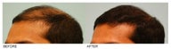 Hair Transplant
