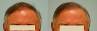 Hair Transplant