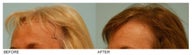 Female Hair Transplant