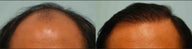 Hair Transplant