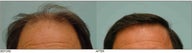 Hair Transplant