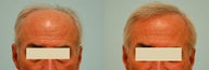 Hair Transplant