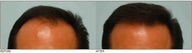 Hair Transplant