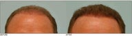 Hair Transplant