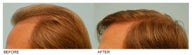 Hair Transplant