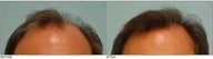Hair Transplant