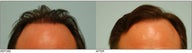 Hair Transplant